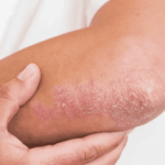 Luz contra la psoriasis: una nueva vía terapéutica sin efectos secundarios