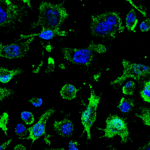 Un ensayo clínico abre una nueva vía contra la ELA: un fármaco español entra en fase de pruebas en humanos