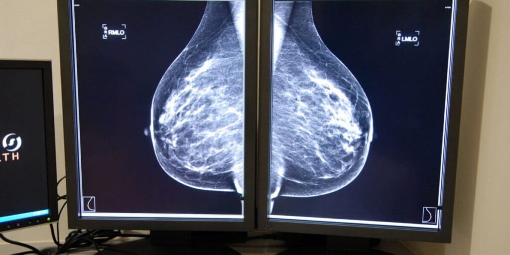 El cribado de cáncer de mama en la Región de Murcia deja atrás diagnósticos clave: un informe apunta a retrasos evitables en el 10% de los casos