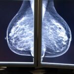 El cribado de cáncer de mama en la Región de Murcia deja atrás diagnósticos clave: un informe apunta a retrasos evitables en el 10% de los casos