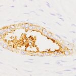 Un test experimental detecta en minutos un biomarcador del cáncer de páncreas con una muestra de sangre
