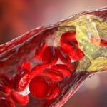 La aterosclerosis empieza mucho antes de lo que pensamos: ya aparece en jóvenes de 18 a 29 años